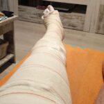 La pierna escayolada de Roberto Martín tras su lesión
